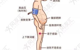 糖皮质激素的副作用,糖皮质激素副作用全面解析